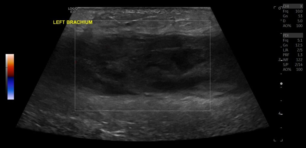 PDI showing no evidence of vascularity within the haematoma