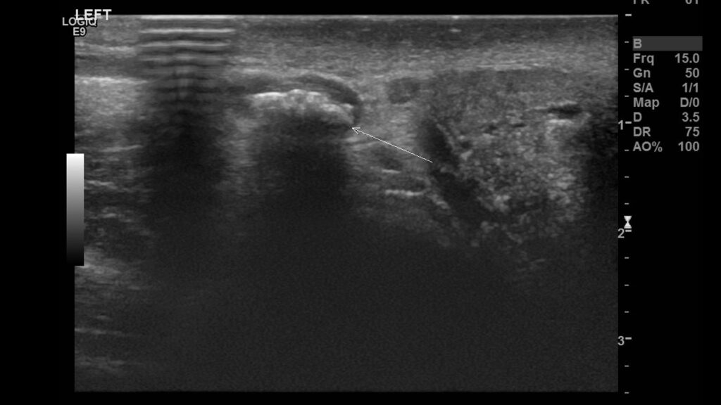  B-mode sonogram showing the calcification within the left spermatic cord