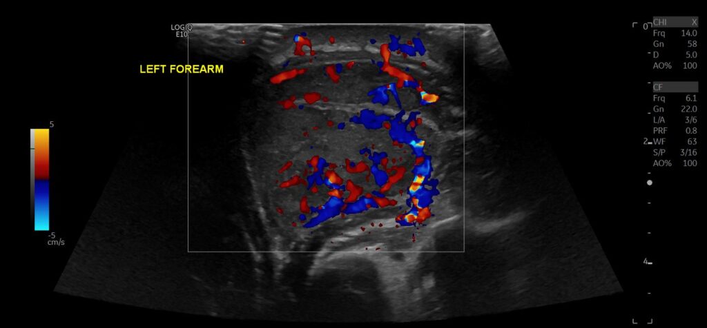 Intramuscular abscess of the forearm transverse view