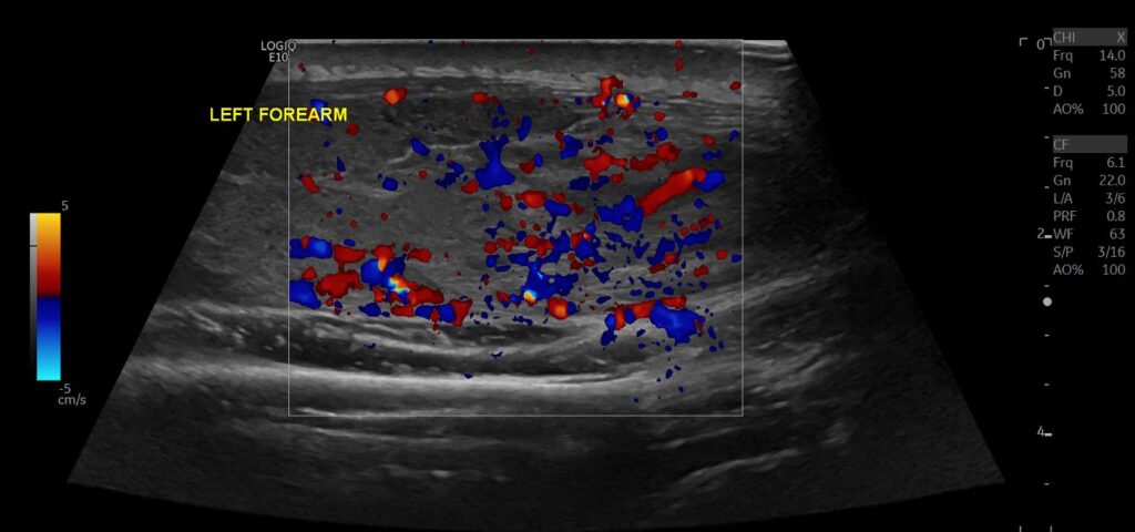 CDI showing hypervascularity in axial view