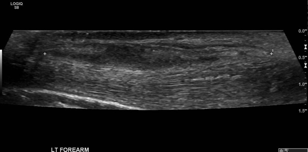  Ultrasound 3 months later revealing a significant reduction in the abscess