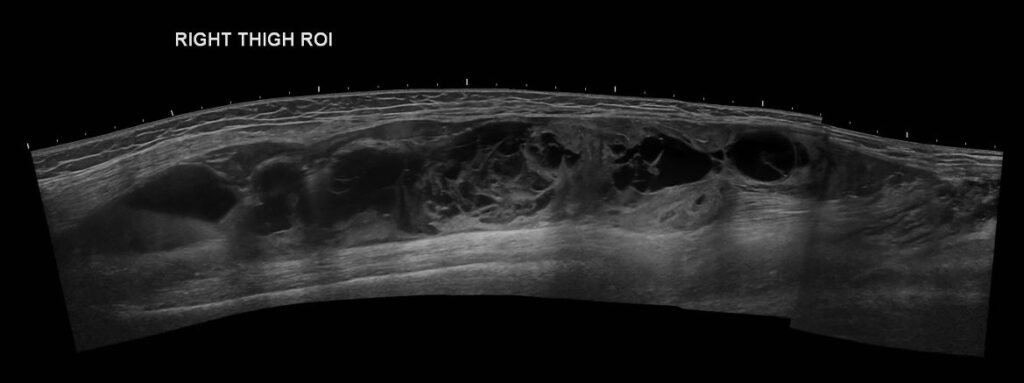 Panoramic view of the right thigh intramuscular haematoma