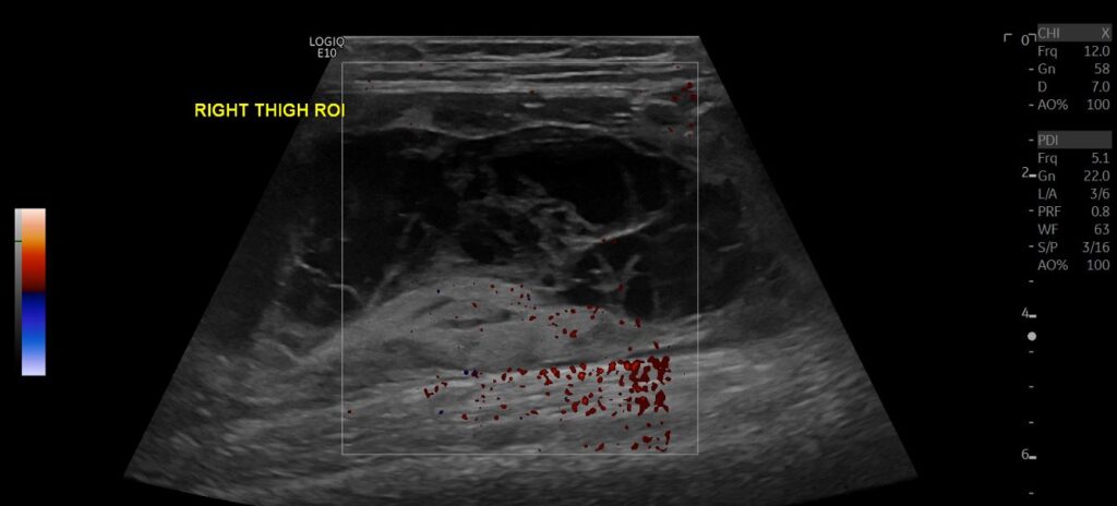 PDI showing no flow signal in the haematoma