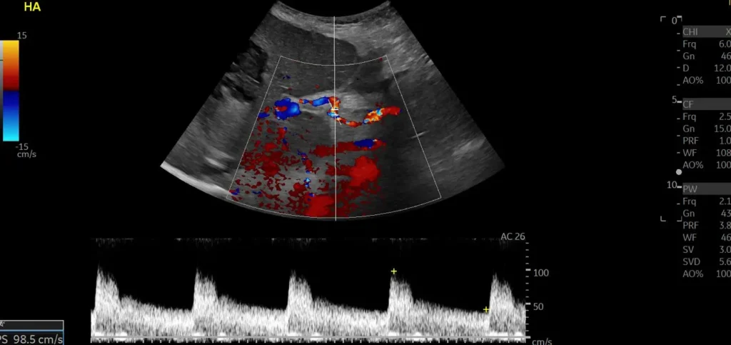 Spectral Doppler of the patent hepatic vein