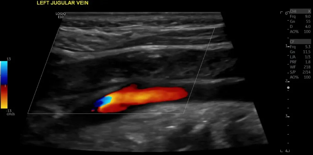 CDI occluded left jugular vein