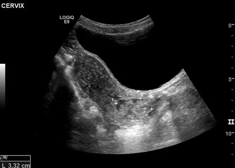 Cervical lesion (cervical mass) in longitudinal view with callipers

