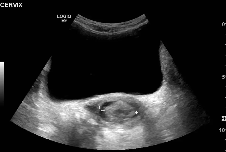 Cervical lesion in axial view with callipers