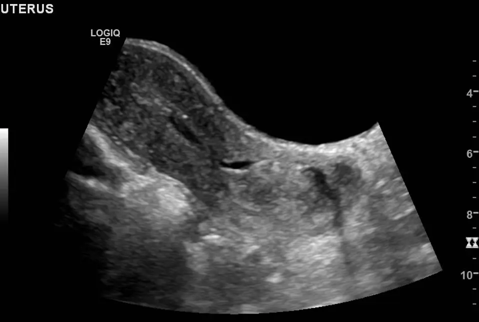 Endometrial cavity fluid
