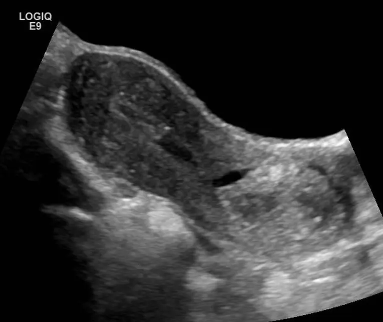 Echogenic content in the endometrium about to migrate into the cervix