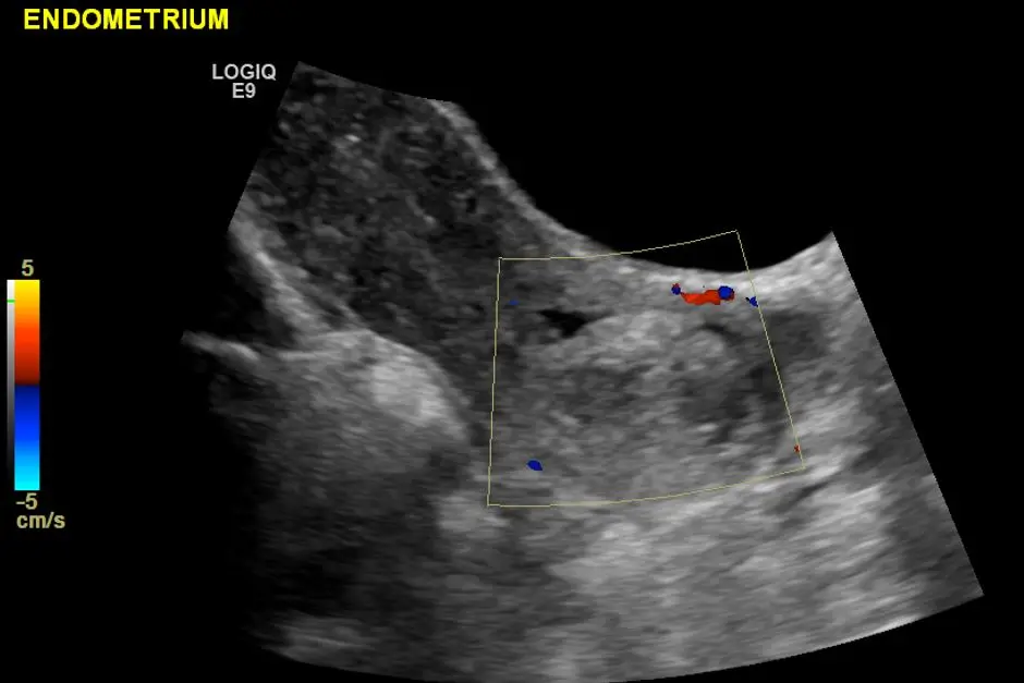 CDI showing no flow in the cervical lesion