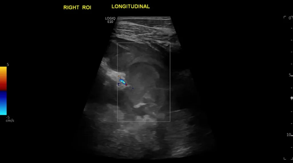 CDI showing no flow in the right thigh haematoma