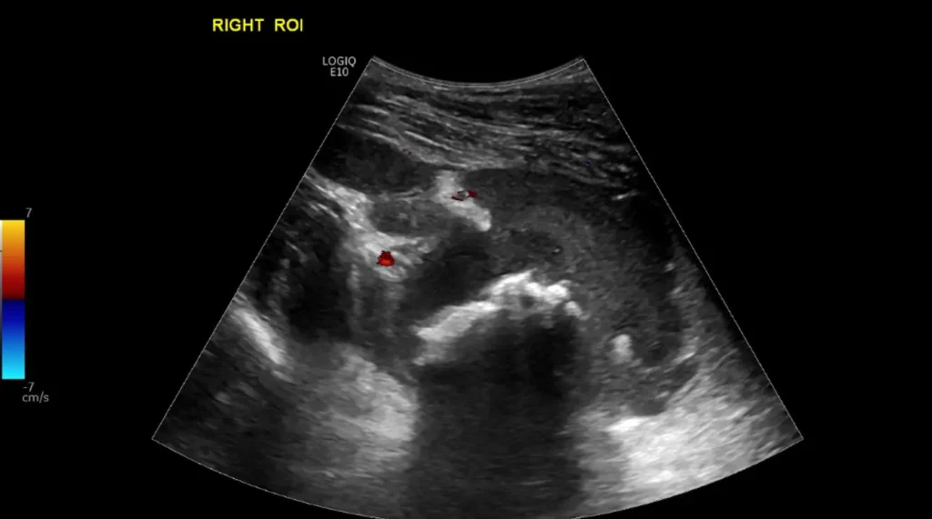 CDI right thigh haematoma (intramuscular haematoma)