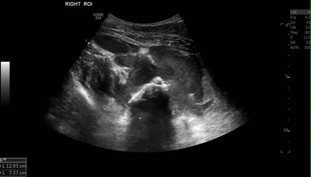 Right thigh haematoma with measurement callipers