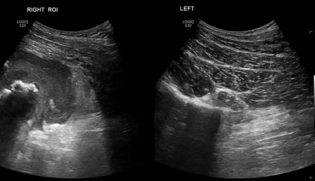 Right and left comparison image of the upper thigh at the level of the haematoma
