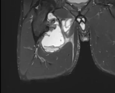 Coronal MRI showing the right thigh haematoma
