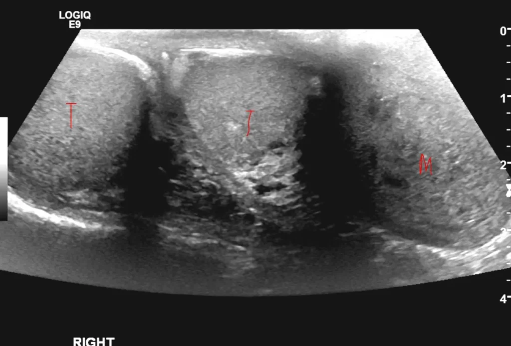 Right and left testes (T) with the mass (M) laterally

