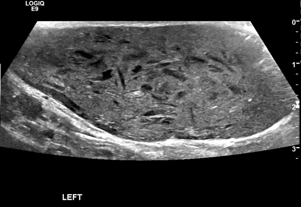 Left hemiscrotal heterogeneous mass