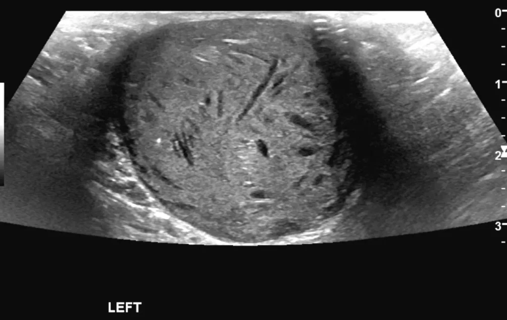 Axial view of the left hemiscrotal mass  (epidermoid cyst)