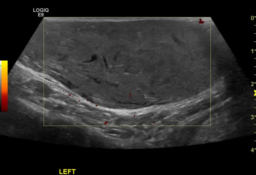 PDI showing no flow signal in the mass