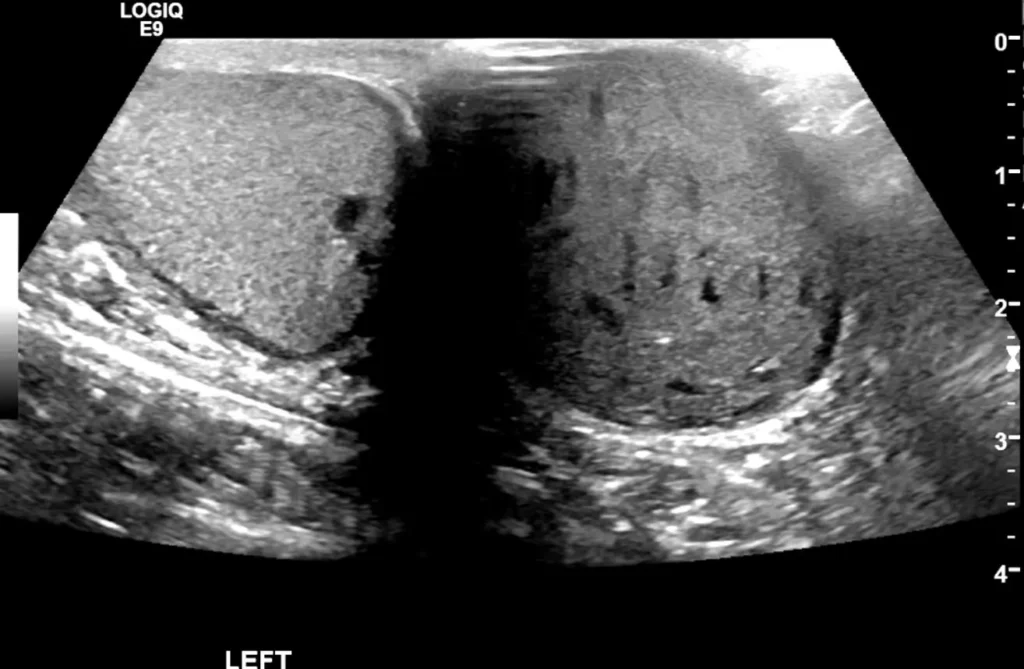 B-mode shoeing the left hemiscrotal mass lateral to the left testis