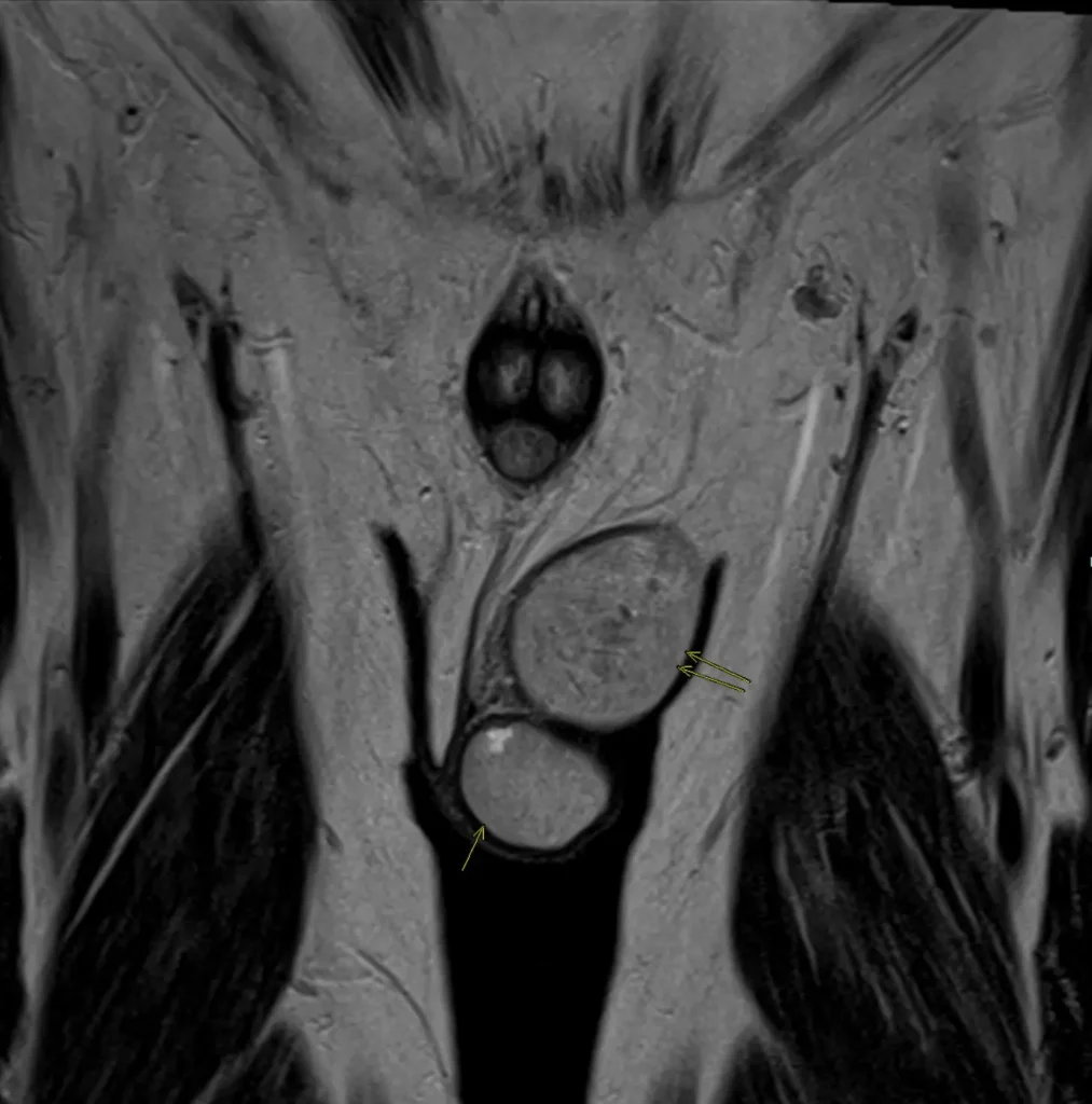 Coronal MRI showing the left hemiscrotal mass (double arrows) next to the left testis (single arrow)