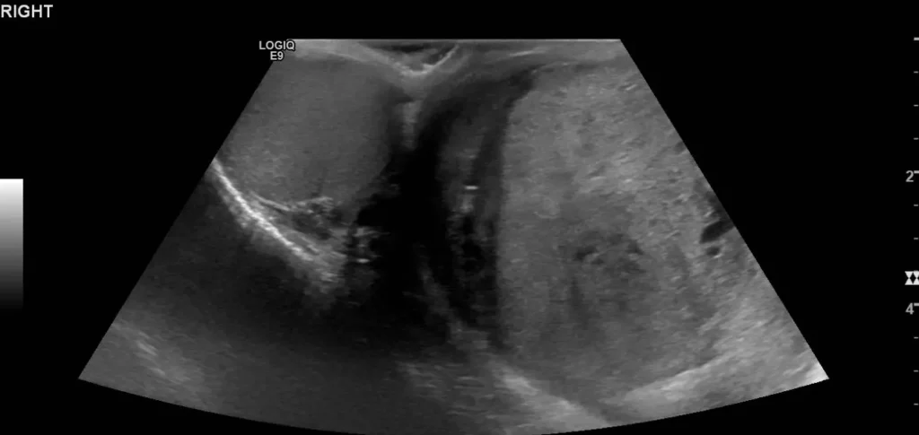  B-mode of the left testicular mass next to the normal right testis

