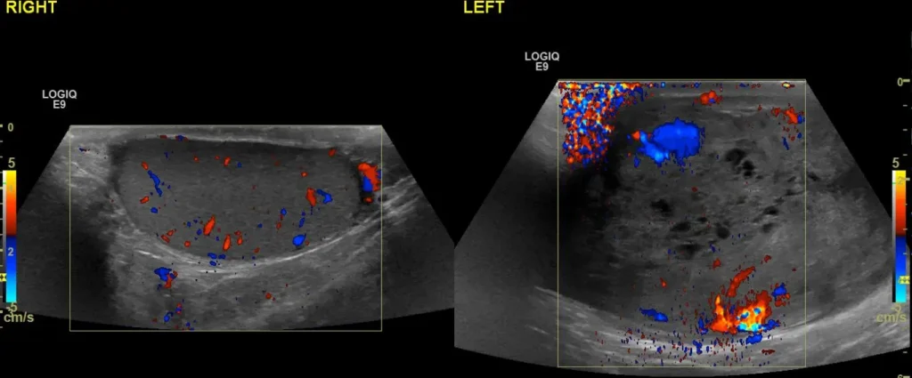 CDI comparing the vascularity of the testes