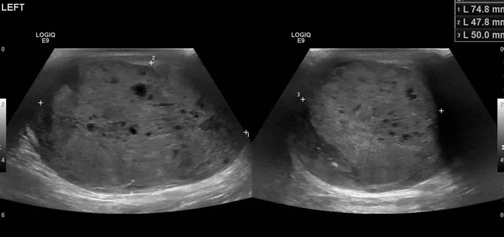 Left testicular mass with measurement callipers in longitudinal and axial views