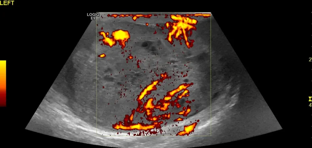  PDI of the left testicular mass (tumour) showing some internal vascularity
