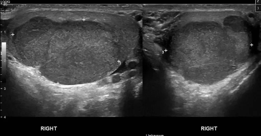 Right testicular mass with measurement callipers longitudinal and axial views