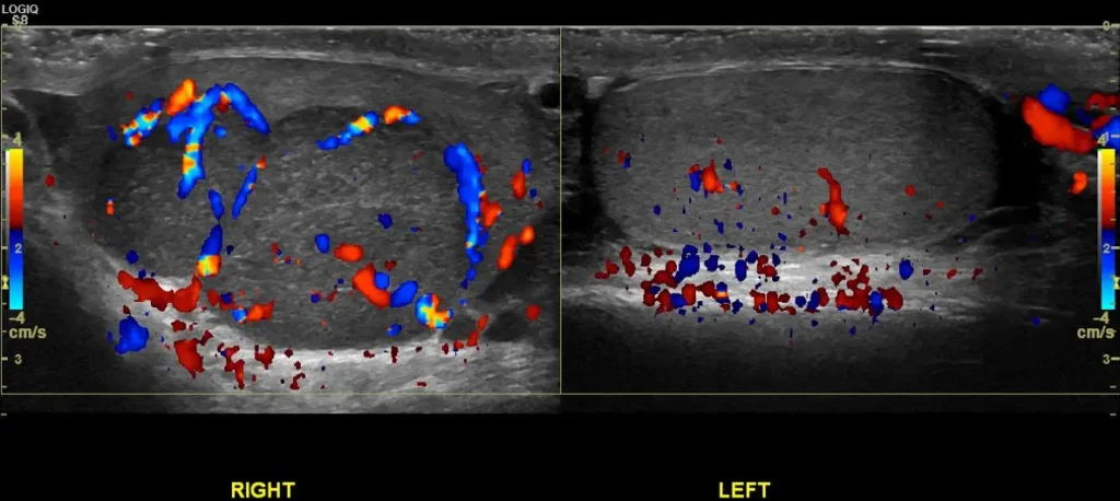 Dual screen image of the right and left testes on CDI